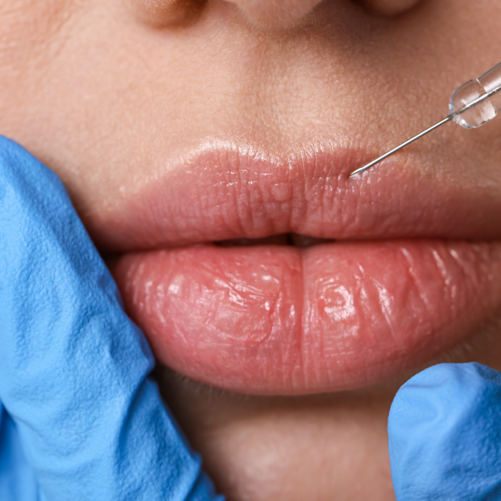 Lip enhancement