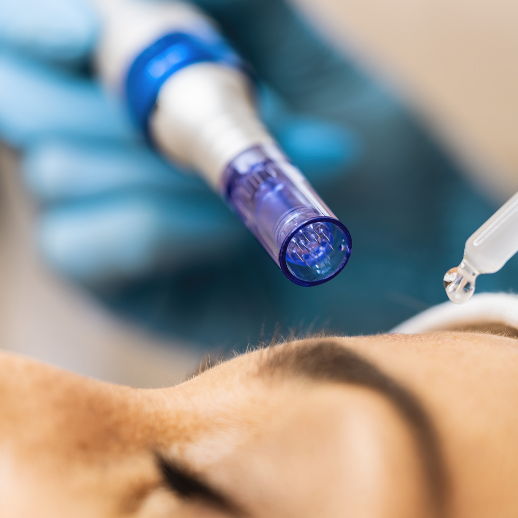 Microneedling with Exosome