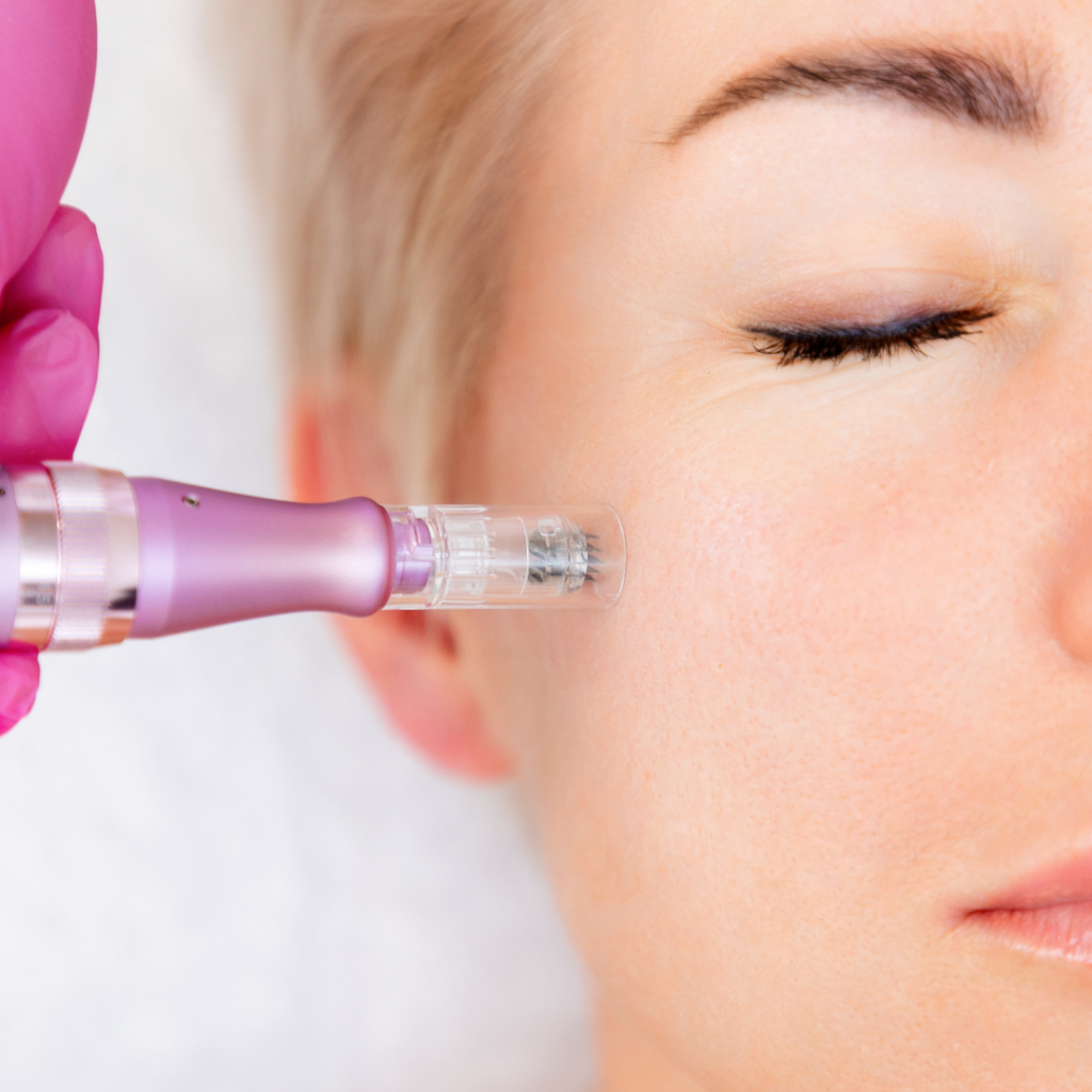 Microneedling with skin Booster